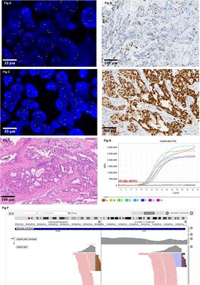 Evaluation of NTRK Gene Fusion by Five Different Platforms in Triple-Negative Breast Carcinoma